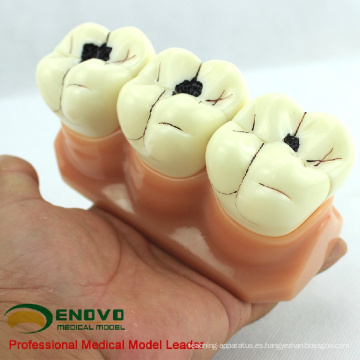 VENDER Modelo de dientes de demostración 12575 caries para comunicación de enseñanza dental